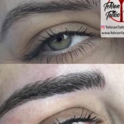 فیبروز ابرو چیست و چگونه انجام میشود
